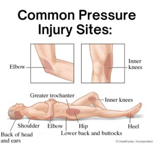 Pressure Injury sites